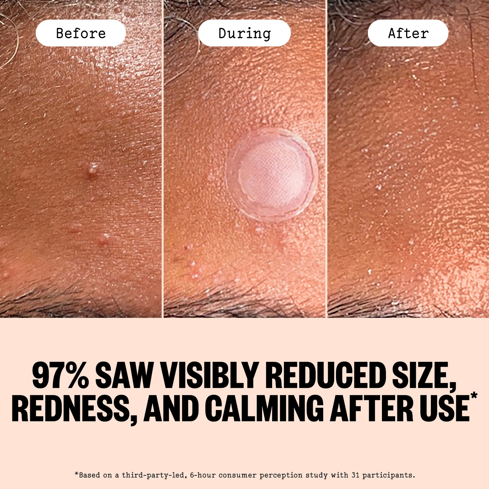 Before and after of Peace Out Early Stage Acne Dot with a claim 97% of participants saw visibly reduced size, redness, and calming after use