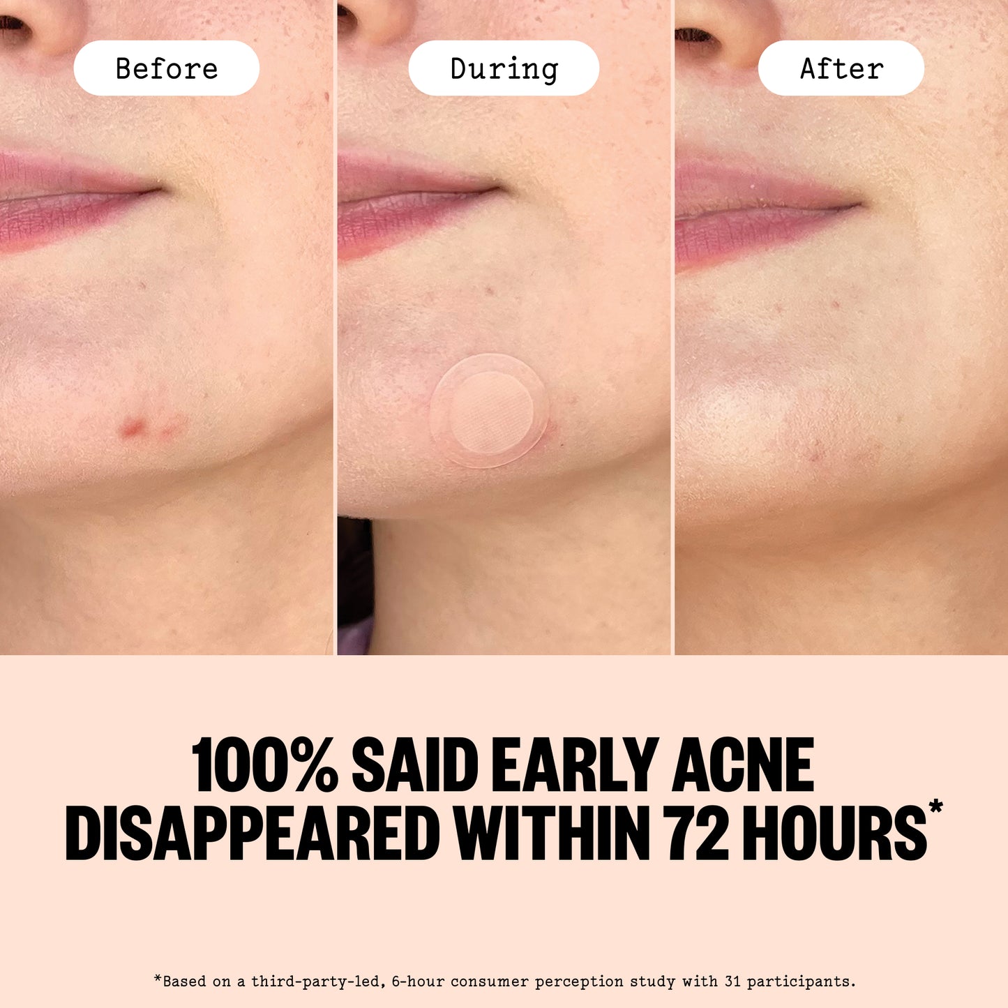 Before, During, and After of Early Stage Acne Dot with the consumer claim - 100% of participants said Early acne disappeared within 72 hours