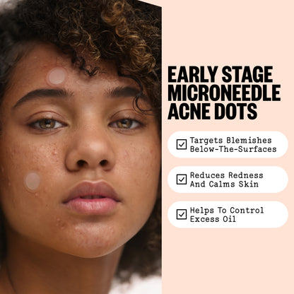 A close-up of a woman's face with visible blemishes and acne dots, next to text that reads 'EARLY STAGE MICRONEEDLE ACNE DOTS' with three benefit bullet points on a pale peach background.