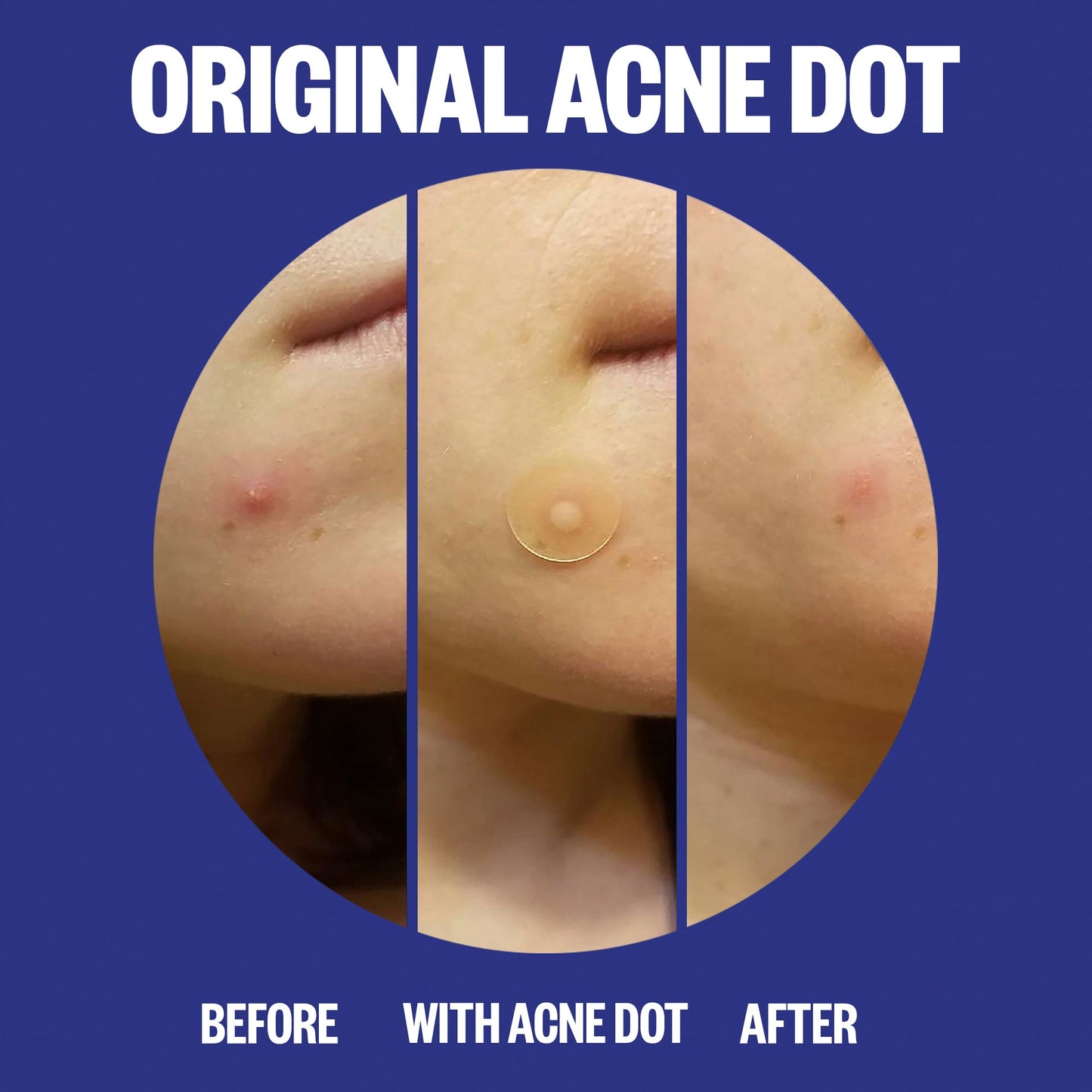 Acne Day & Night Duo (CAN)