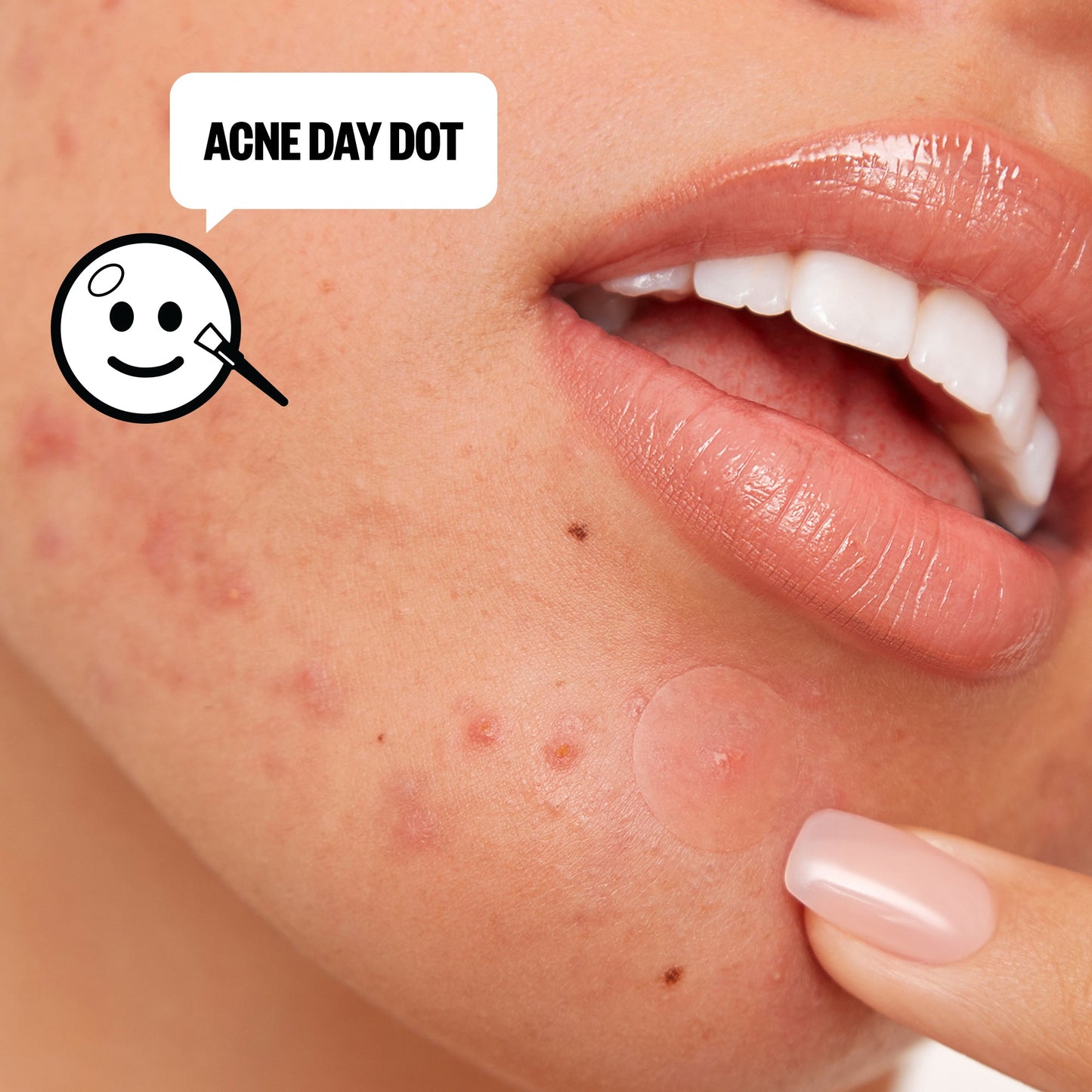 Acne Day & Night Duo (CAN)