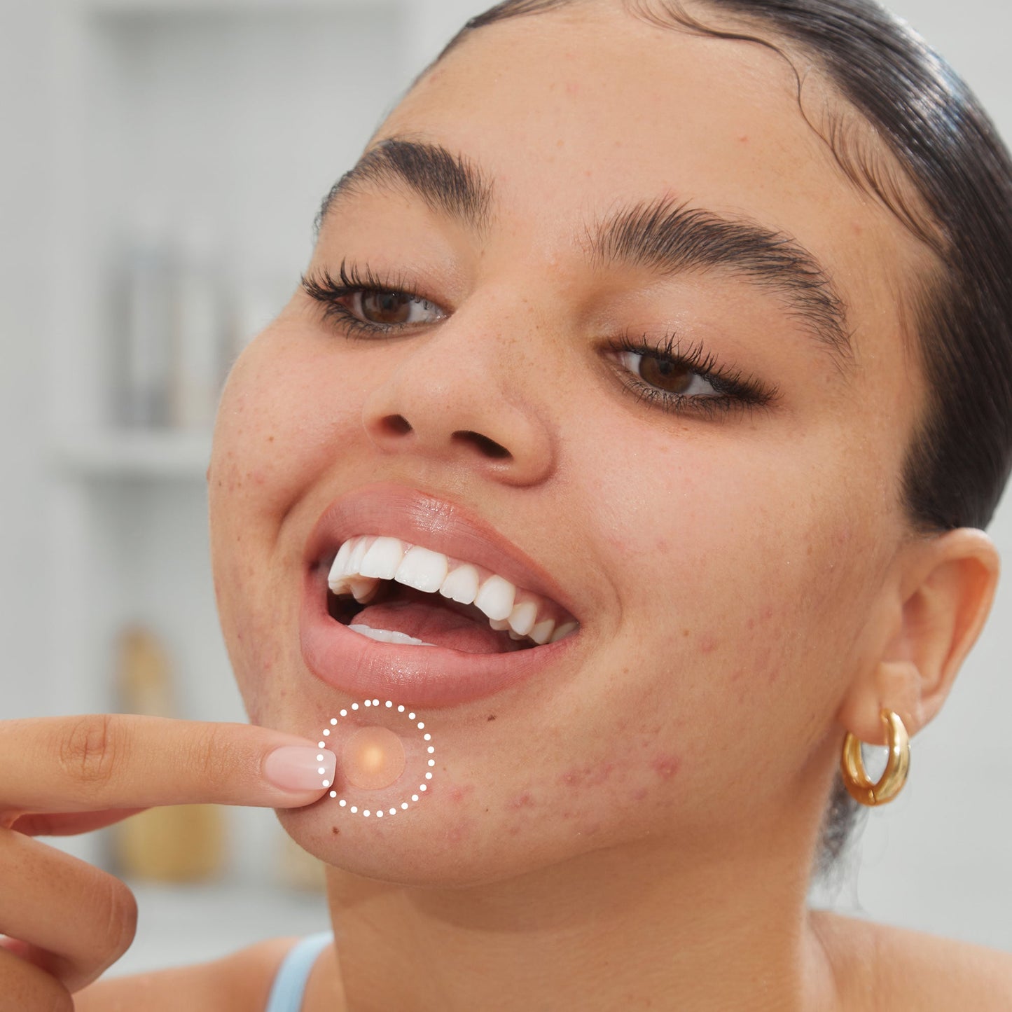 Acne Treatment Dots (CAN)