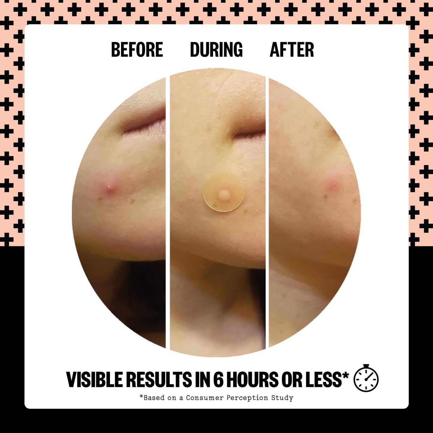 Acne Treatment Dots (CAN)