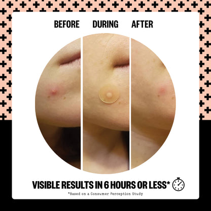 Acne Treatment Dots (CAN)