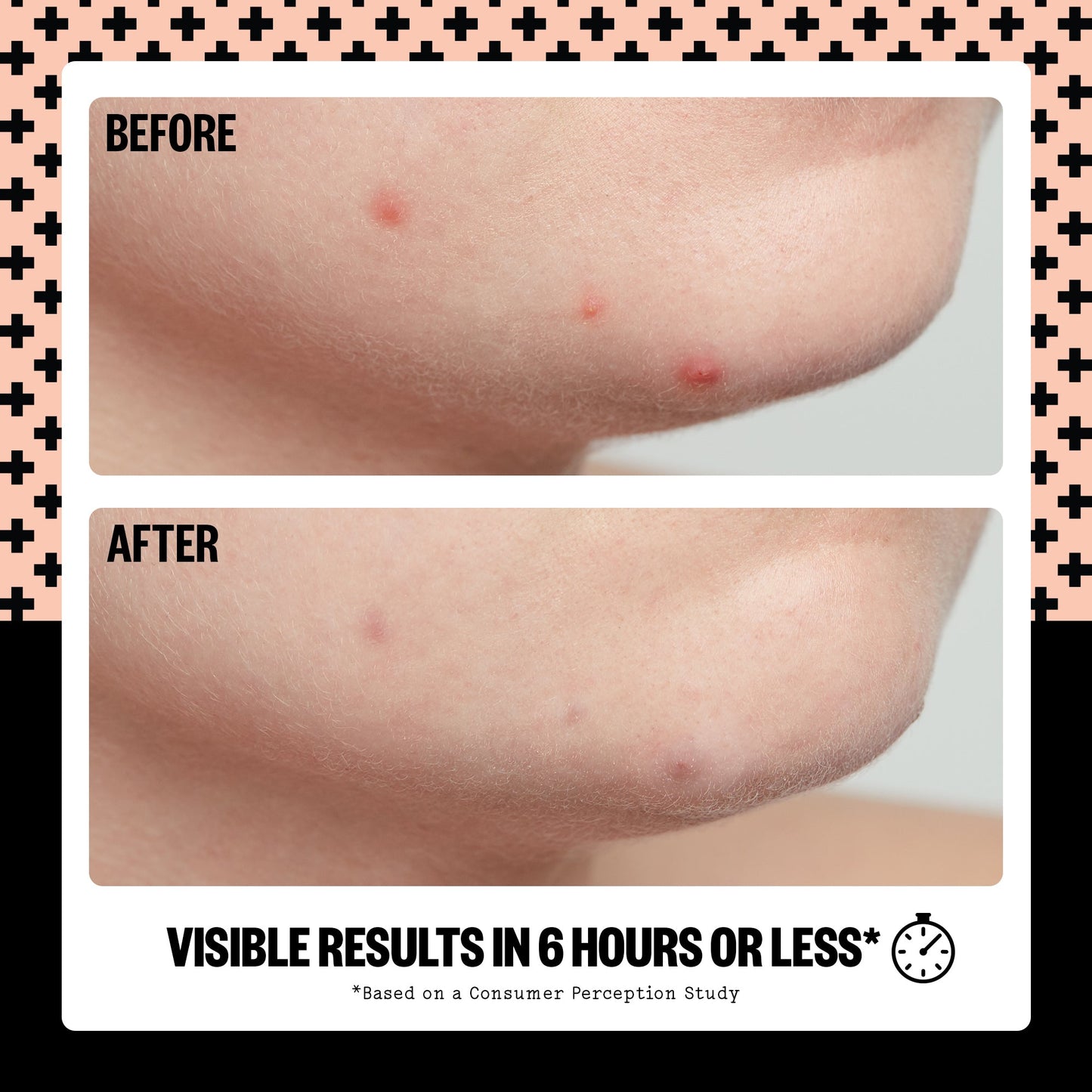 Acne Treatment Dots (CAN)