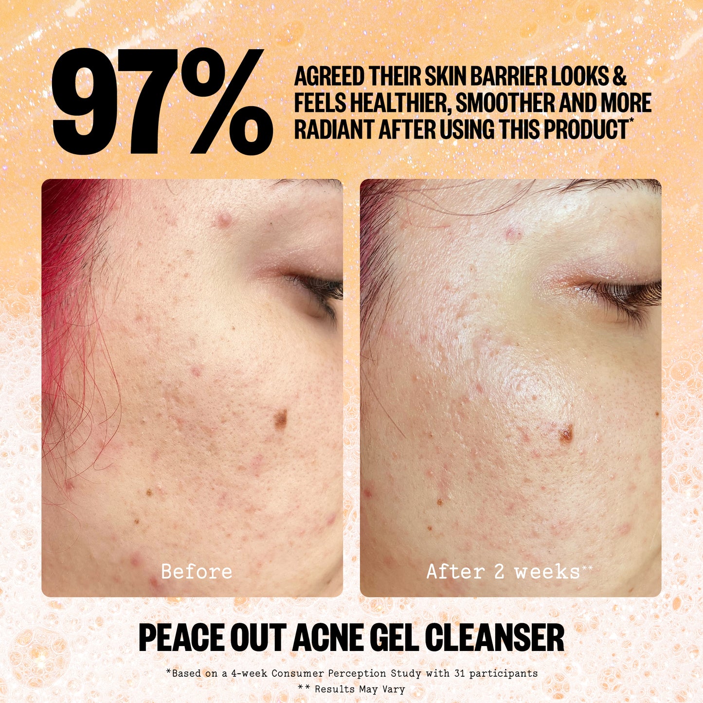 Acne Gel Cleanser