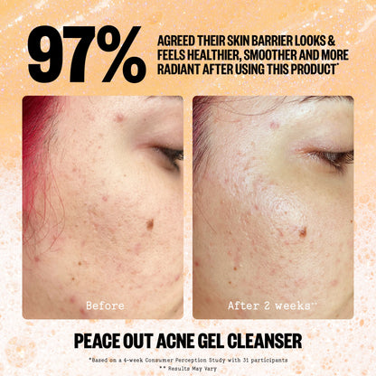 Acne Gel Cleanser (CAN)