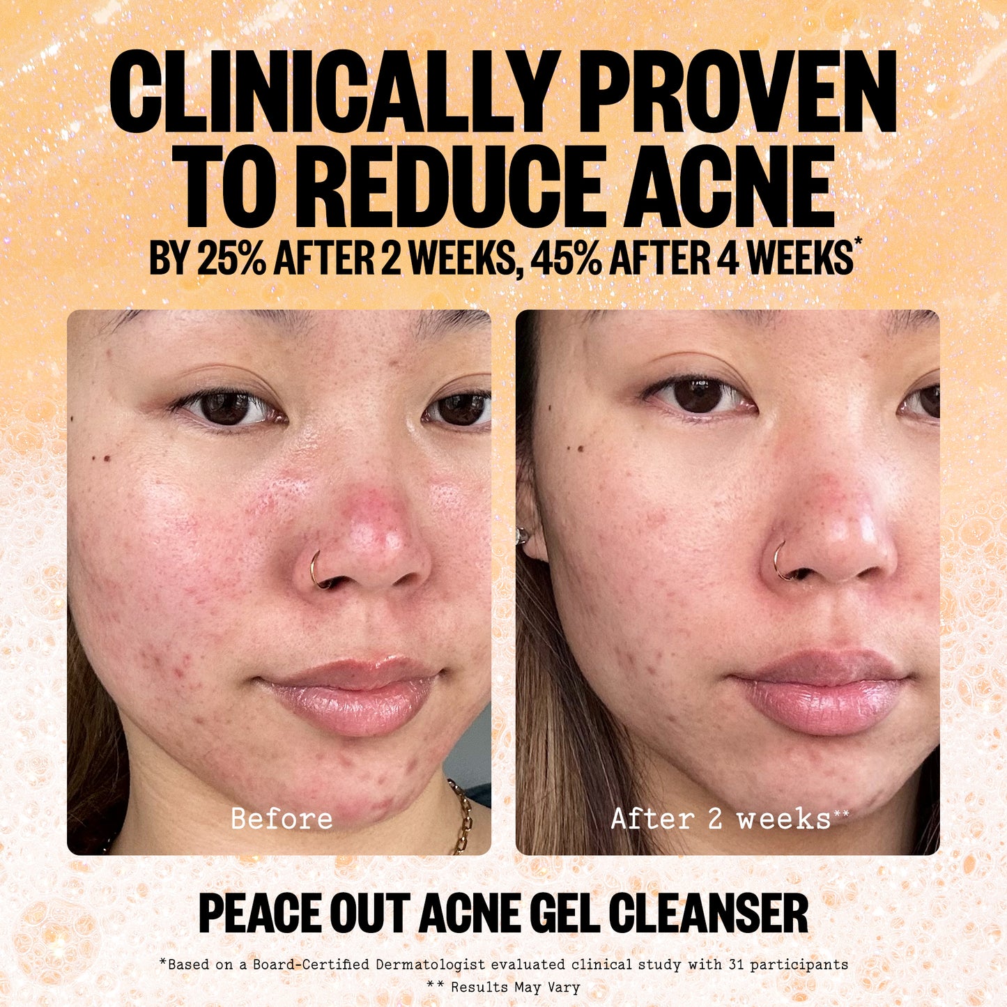 Acne Gel Cleanser (CAN)