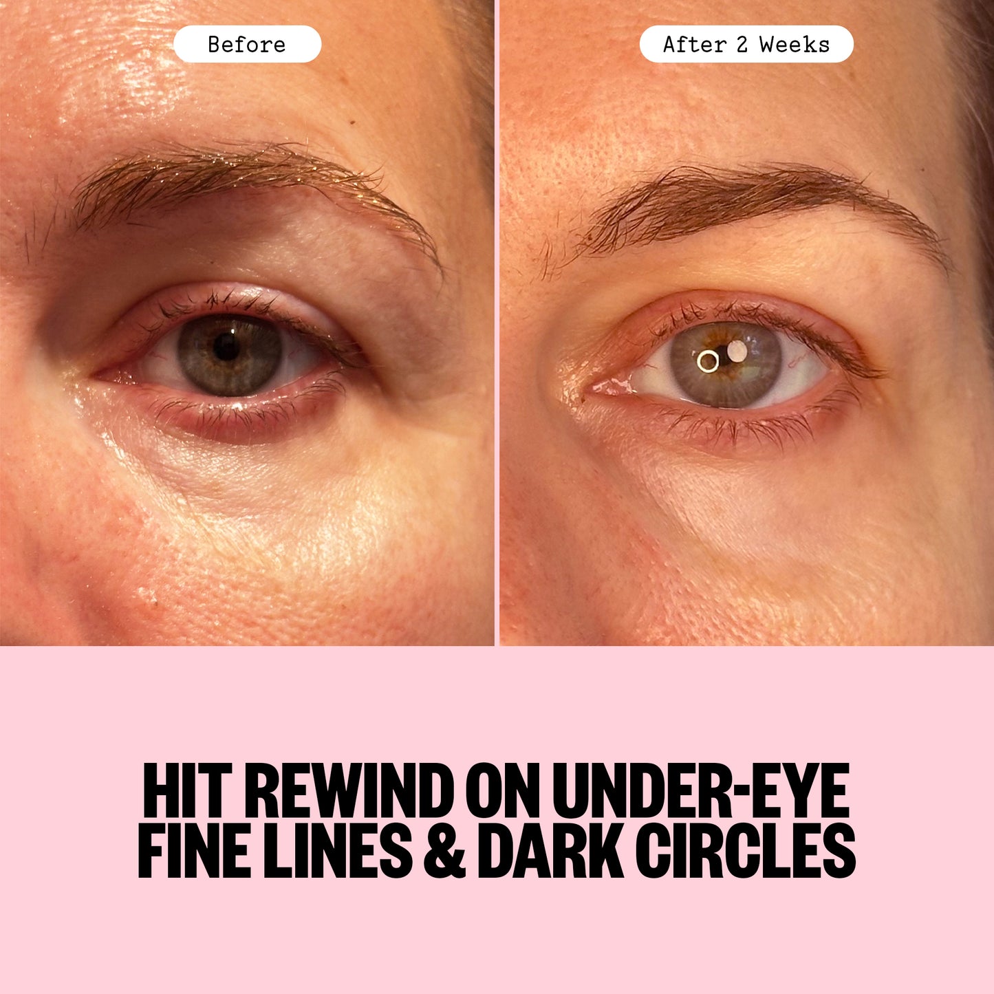 Before and after comparison of under-eye fine lines and dark circles via Peace Out Retinol Eye Jelly Stick treatment on a person's eye area.
