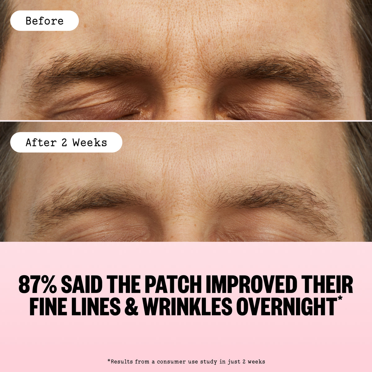 Before-and-after comparison of a man's forehead and eyebrows, with the top labeled 'Before' and the bottom labeled 'After 2 Weeks'. The lower portion features a pink banner with the text '87% SAID THE PATCH IMPROVED THEIR FINE LINES & WRINKLES OVERNIGHT'.
